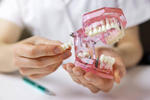 Smile Again with Dental Implants in Fort Worth