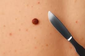 Mole Removal Success Rate by Method